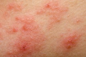 9 natuurlijke middelen tegen rosacea