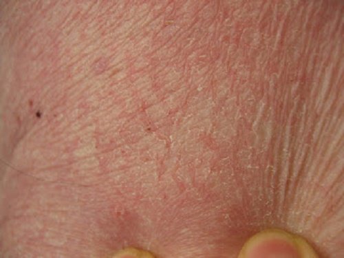 Droge Huid