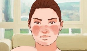 7 behandelingen voor het reguleren van lupus