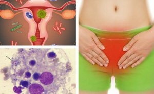 Tips om vaginale schimmelinfecties te vermijden en te verzachten