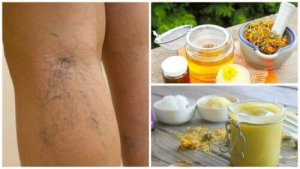 Behandel spataderen en teleangiëctasieën met deze arnicazalf