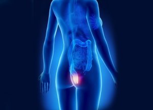 9 natuurlijke remedies tegen aambeien