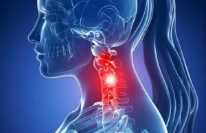 Cervicale spondylose: symptomen en behandelingen met natuurlijke middelen