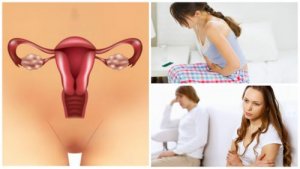 7 dingen die je moet weten over Polycysteus Ovarium Syndroom