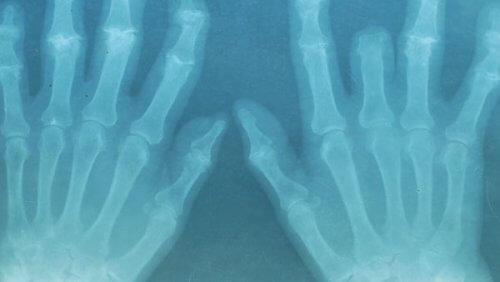 Gewrichtspijn verminderen met etherische olie