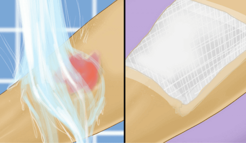 Eerste hulp bij brandwonden door kokend water