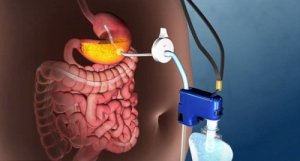 Ontdek een nieuwe technologie om overgewicht te verhelpen