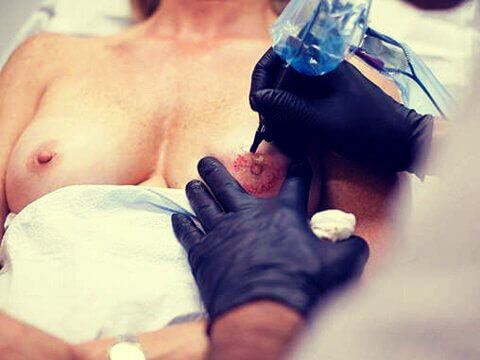 Tatoeage na borstkanker