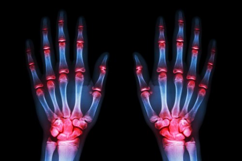 Handen met osteoartritis