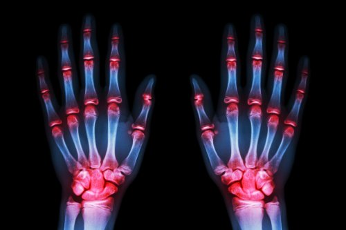 Handen met osteoartritis