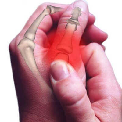 Pijnlijke duim door osteoartritis