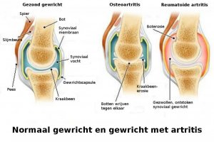 De verschillen tussen artritis, osteoartritis en osteoporose