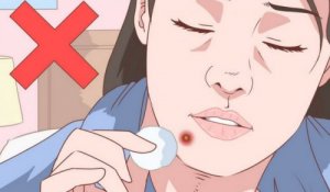 Een natuurlijke behandeling voor acne op je kin