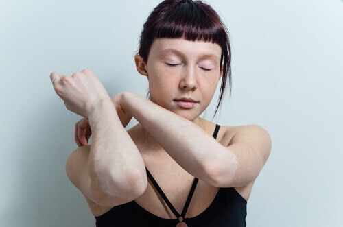 Vrouw met bleke armen door vitiligo