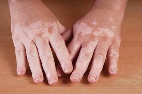 Middelen tegen vitiligo