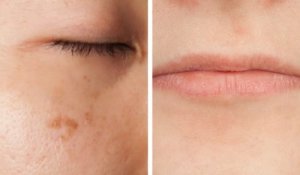 5 manieren waarop je gezicht waarschuwt als je een vitaminedeficiëntie hebt