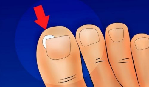 Hoe kun je ingegroeide nagels voorkomen en behandelen?