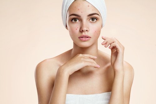 Acne van binnenuit behandelen