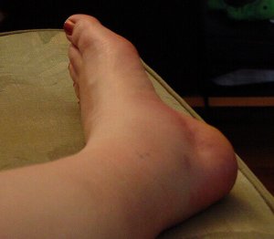 5 waarschuwingen die opgezette enkels kunnen onthullen