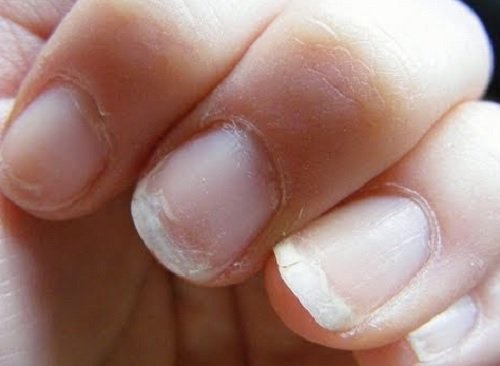 Een Slechte Bloedsomloop en nagelgroei