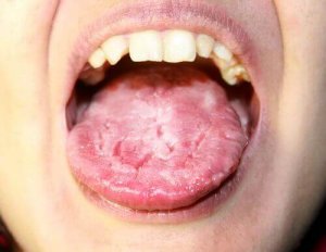 Wat is candidiasis?