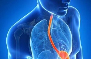 10 vreemde symptomen van zure reflux