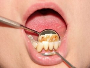 Tips om tandsteen natuurlijke wijze te - Leven