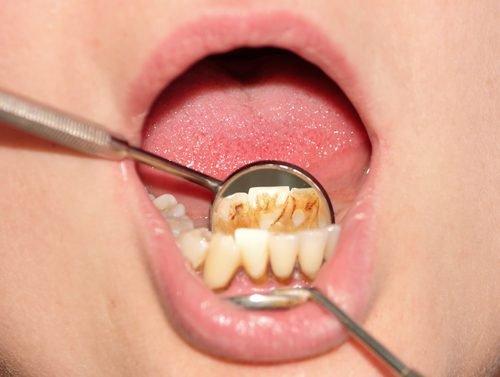 Tips om tandsteen op natuurlijke wijze te verwijderen