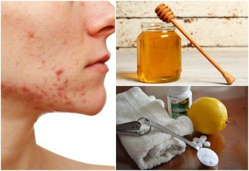 6 natuurlijke remedies voor cystische acne