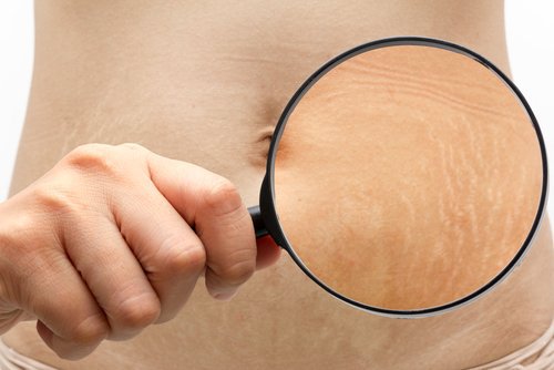6 trucs om het uiterlijk van striae te verbeteren
