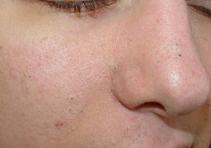 Mee-eters verwijderen met 3 zelfgemaakte exfolianten