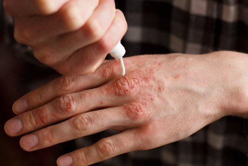 Hoe kun je psoriasis behandelen met lokale toepassingen