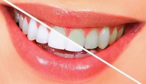 Controversieel residentie Beschrijven Wittere tanden op een natuurlijke manier met 10 voedingsmiddelen.
