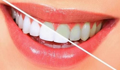 Wittere tanden op een natuurlijke manier met 10 voedingsmiddelen