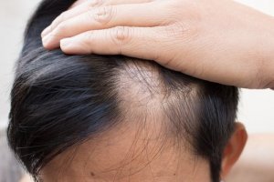 6 natuurlijke behandelingen die kaalheid tegengaan