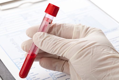 Hartfalen door hemochromatose