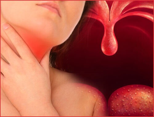 Ontstoken amandelen en keelontsteking natuurlijk behandelen