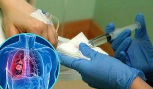 Wetenschappers ontdekken een medicijn om de bijwerkingen van chemotherapie te verlichten