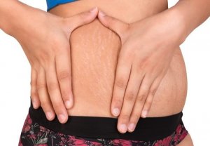 Striae behandelen met deze twee natuurlijke middeltjes