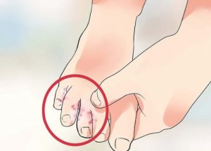 Voetschimmel behandelen met natuurlijke remedies