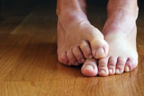 Voetschimmel behandelen met natuurlijke remedies
