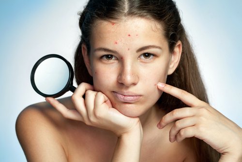 6 stappen om van acne af te komen