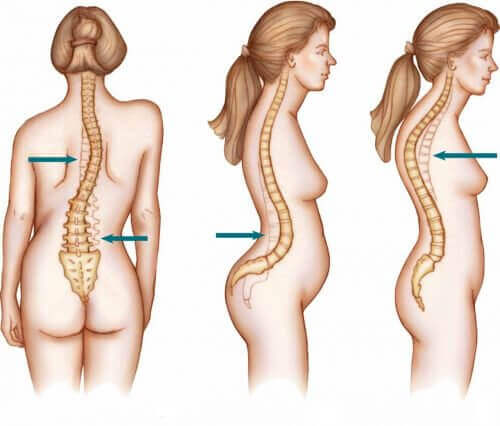 Scoliose beïnvloedt vaker vrouwen