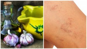Spataderen behandelen met olijfolie en knoflook
