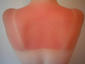 7 remedies om zonnebrand te verlichten