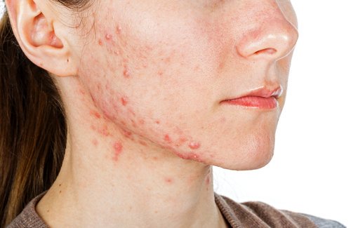 Acne door voedingstekorten