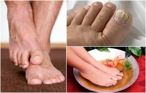 De symptomen van voetschimmel: heb jij ze?