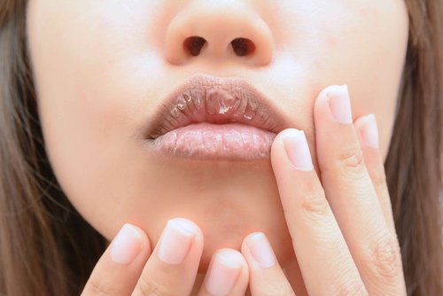 Gebarsten lippen door voedingstekorten