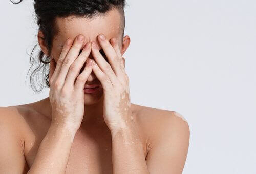 Man die last heeft van vitiligo en daardoor zijn gezicht verbergt
