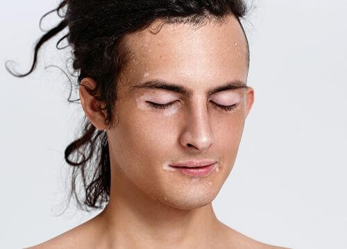 Man met zijn ogen dicht die last heeft van vitiligo